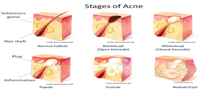 A Comprehensive Review of Acne Vulgaris: Pathogenesis, Clinical ...